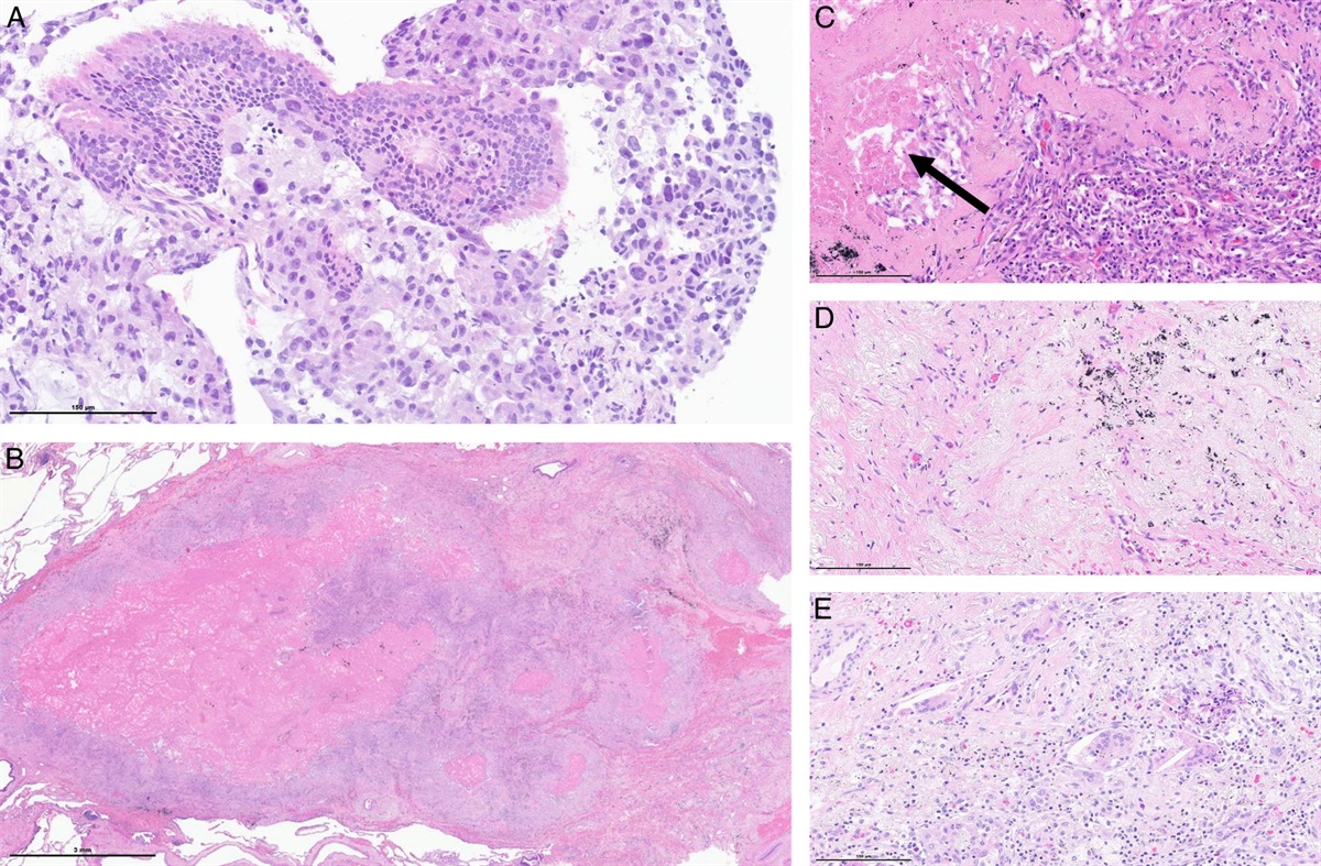 Pathology of Surgically Resected Lung Cancers Following Neoadjuvant Therapy