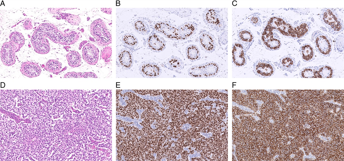 Evolution of Testicular Germ Cell Tumors in the Molecular Era With Histogenetic Implications