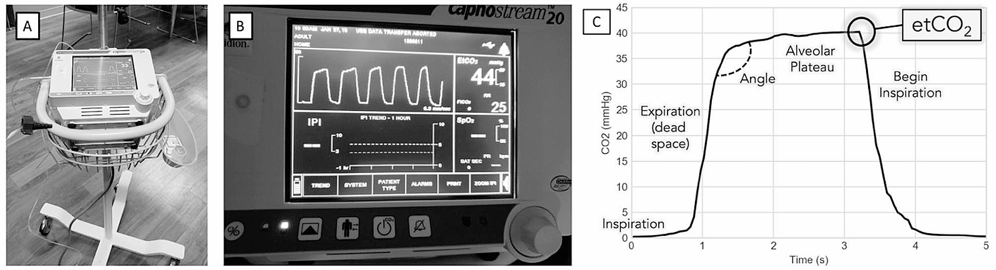 Diagnostic utility of capnography in emergency department triage for screening acidemia: a pilot study