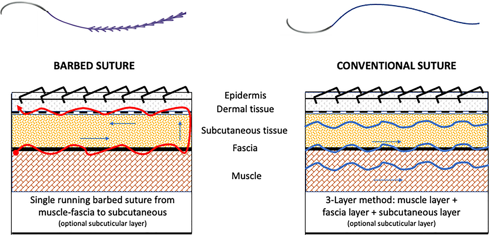 Barbed versus conventional suture in elective posterior spine surgery