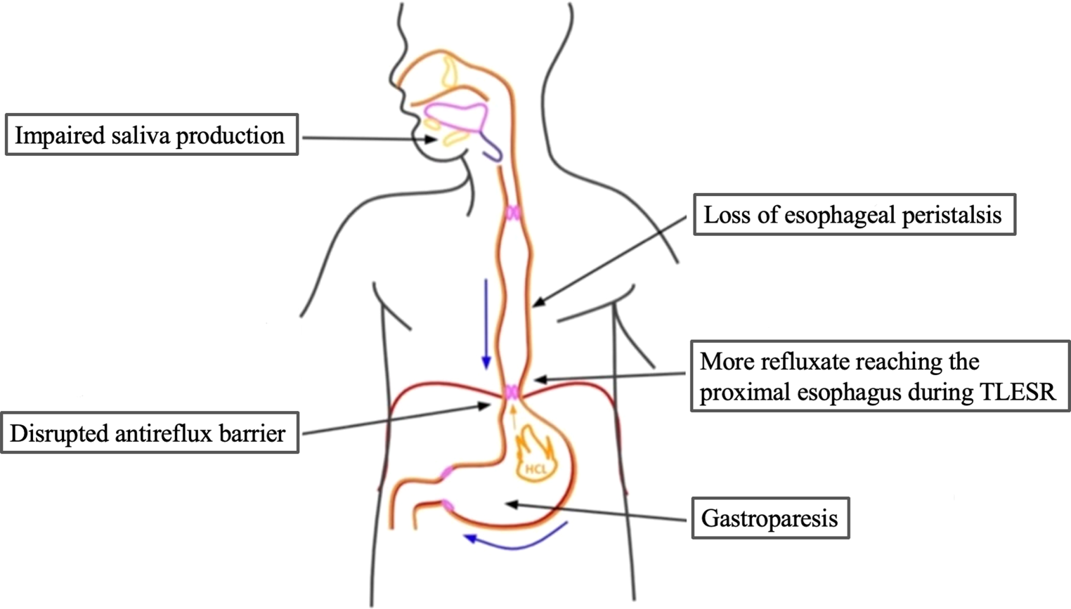 Toupet fundoplication to prevent progression of scleroderma-associated interstitial lung damage: a study protocol