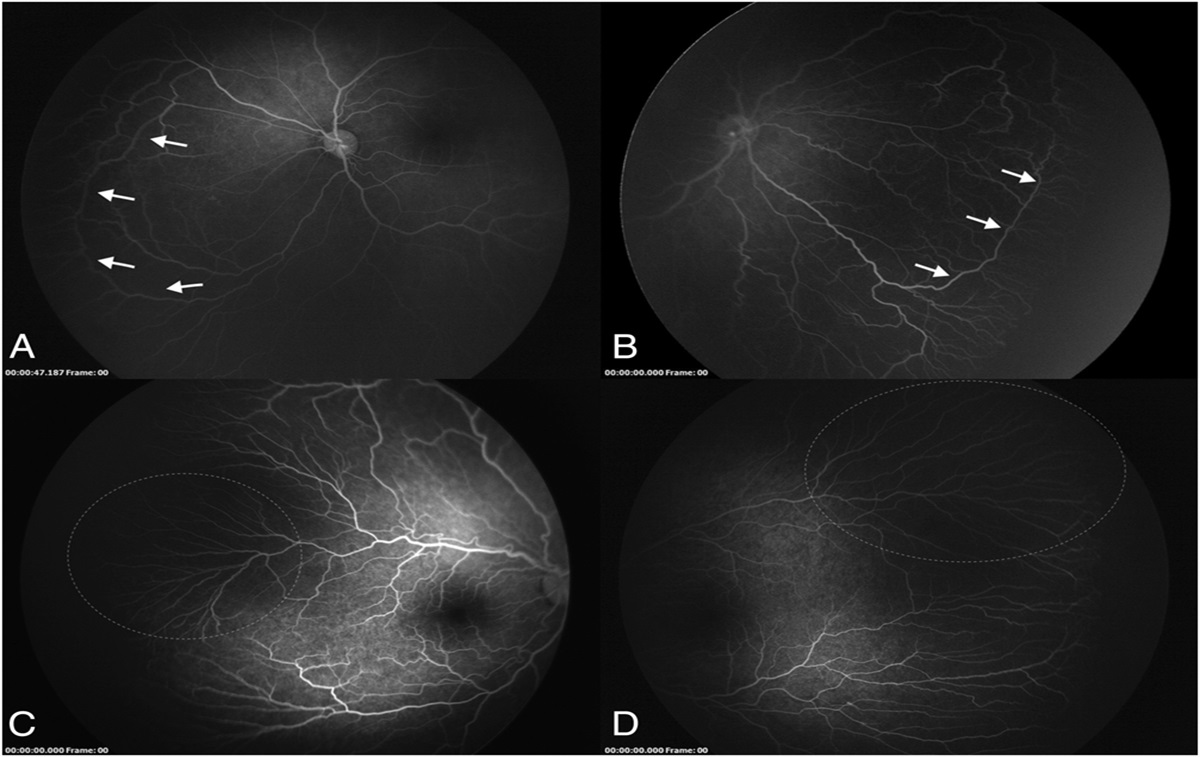 FLUORESCEIN ANGIOGRAPHY EVALUATION OF CHILDREN PREVIOUSLY TREATED WITH ANTI–VASCULAR ENDOTHELIAL GROWTH FACTOR MONOTHERAPY FOR RETINOPATHY OF PREMATURITY