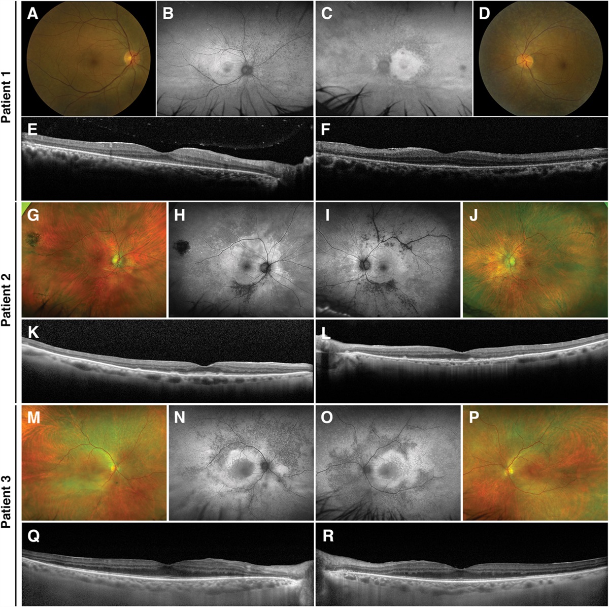 TOWARD AN IMAGING-CENTRIC DEFINITION OF NONPARANEOPLASTIC AUTOIMMUNE RETINOPATHY