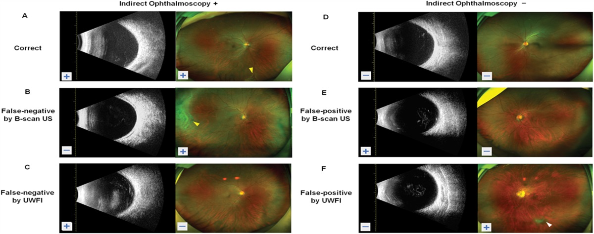 COMBINED APPLICATION OF B-SCAN ULTRASONOGRAPHY AND EYE-STEERING ULTRAWIDE FIELD IMAGING TO IMPROVE THE DETECTION OF RETINAL TEARS BEFORE CATARACT SURGERY
