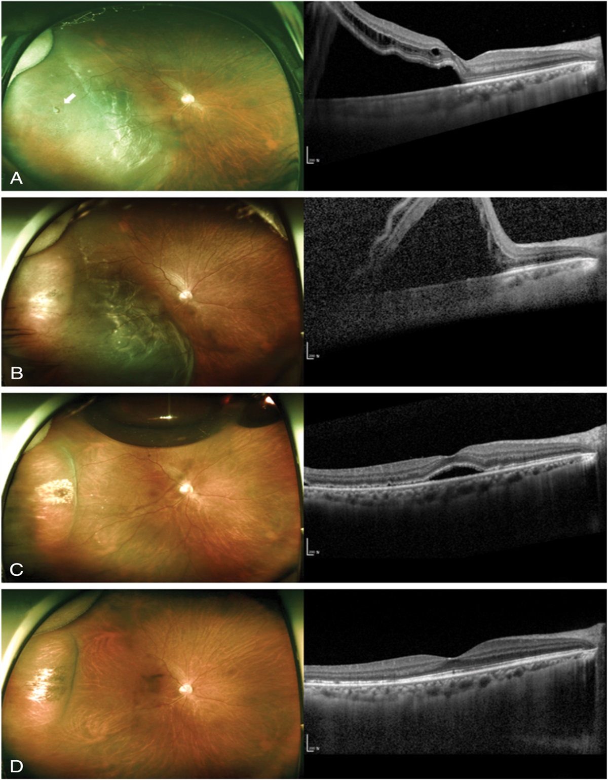 ADDITIONAL PNEUMATIC RETINOPEXY IN PATIENTS WITH PERSISTENT RETINAL DETACHMENT AFTER SCLERAL BUCKLING