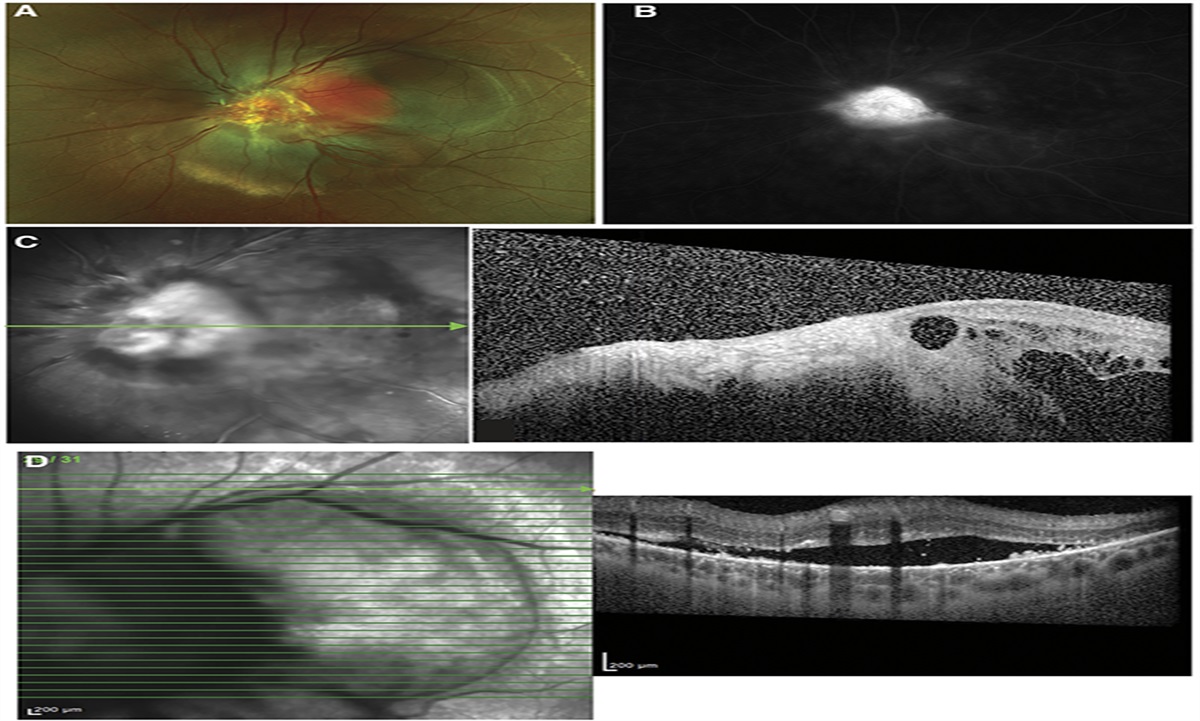 Successful Treatment Response of a Juxtapapillary Retinal Capillary Hemangioblastoma Due to von Hippel–Lindau Syndrome with Belzutifan in a Pediatric Patient