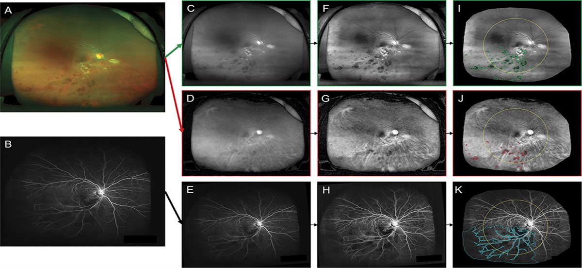 RELATIONSHIP BETWEEN RETINAL HEMORRHAGE ON GREEN AND RED CHANNELS OF ULTRA-WIDEFIELD FUNDUS IMAGES AND RETINAL PERFUSION IN ACUTE BRANCH RETINAL VEIN OCCLUSION