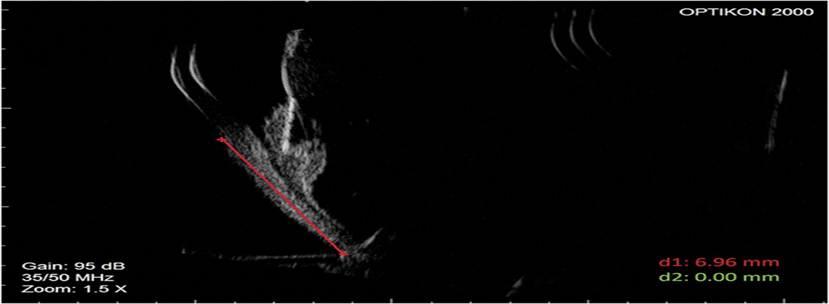 Guided Trocar Insertion in Highly Myopic Eyes