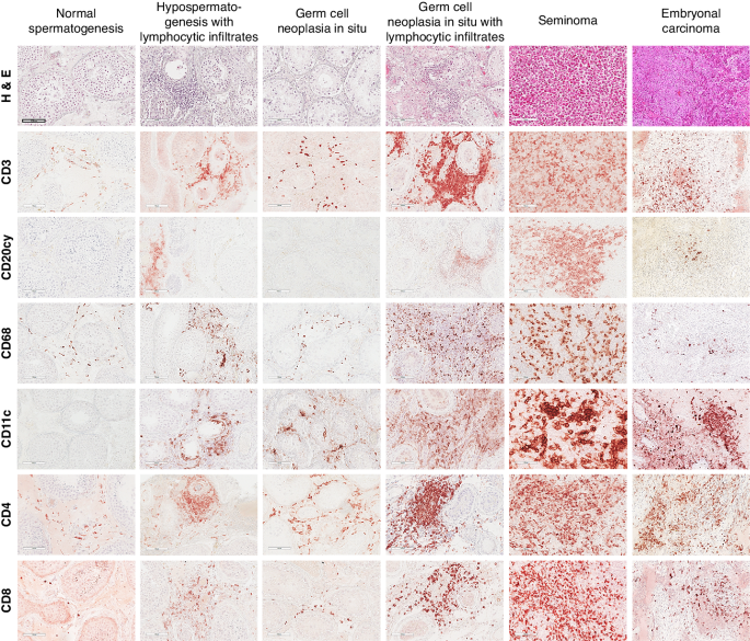 T cells in testicular germ cell tumors: new evidence of fundamental contributions by rare subsets