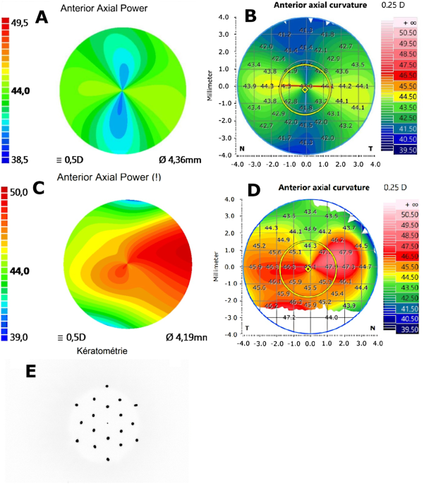 Comparison of corneal topography maps obtained using the IOLMaster 700® and the Anterion® in candidates for toric IOL implantation