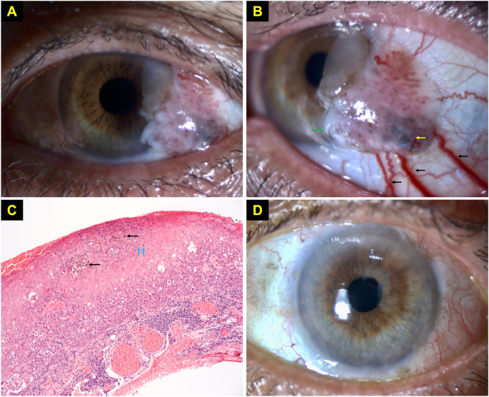 Melanocytic ocular surface squamous neoplasia successfully managed with no-touch excisional biopsy, cryotherapy and amniotic membrane transplantation