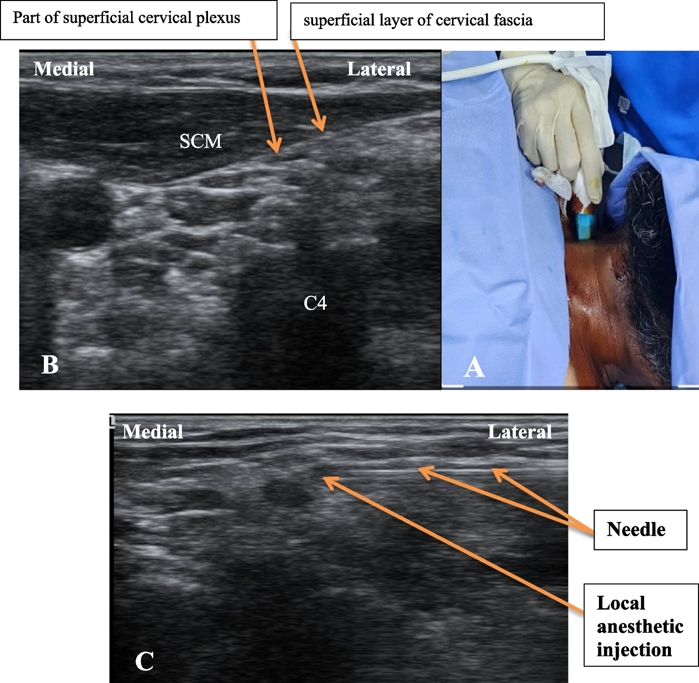 Regional analgesia using ultrasound-guided intermediate cervical plexus block versus cervical erector spinae block for anterior cervical spine surgery: a randomized trial