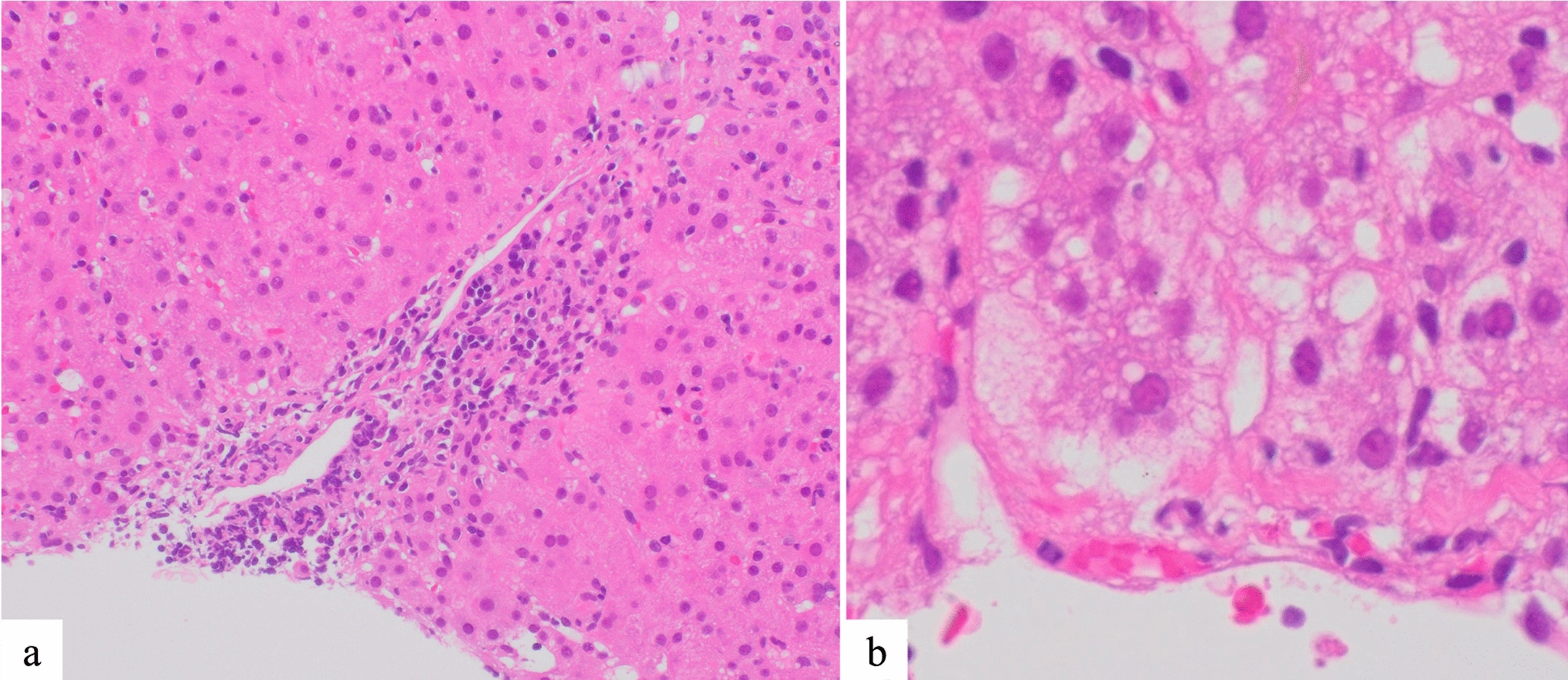 Simultaneous occurrence of autoimmune hepatitis and autoimmune hemolytic anemia after COVID-19 infection: case report and literature review