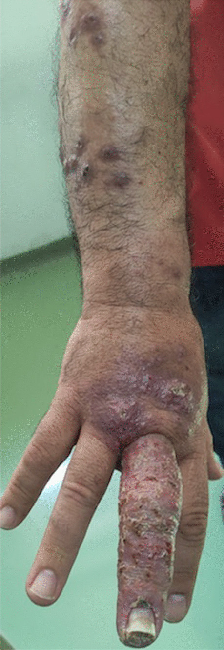 Mycobacterium marinum infection in a patient with Crohn’s disease on anti-tumor necrosis factor treatment