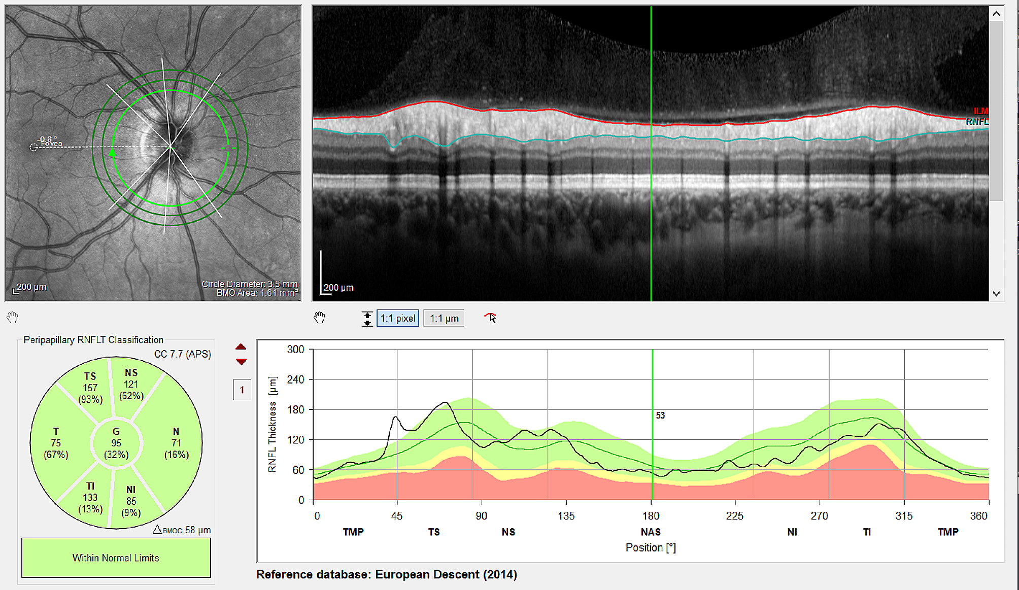 Effect of intravitreal injections due to neovascular age-related macular degeneration on retinal nerve fiber layer thickness and minimum rim width: a cross sectional study