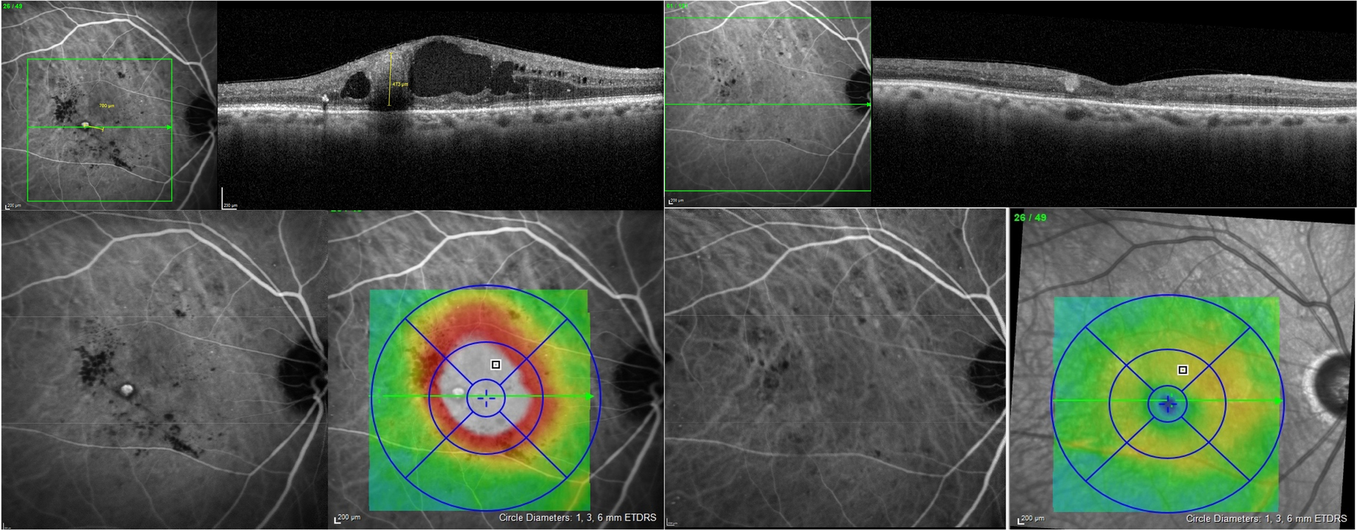 Photocoagulation or sham laser in addition to conventional anti-VEGF therapy in macular edema associated with TelCaps due to diabetic macular edema or retinal vein occlusion (TalaDME): a study protocol for a multicentric, French, two-group, non-commercial, active-control, observer-masked, non-inferiority, randomized controlled clinical trial