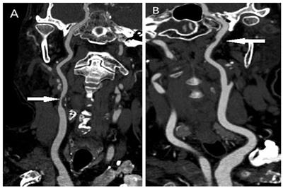 Residual inflammatory risk and vulnerable plaque in the carotid artery in patients with ischemic stroke