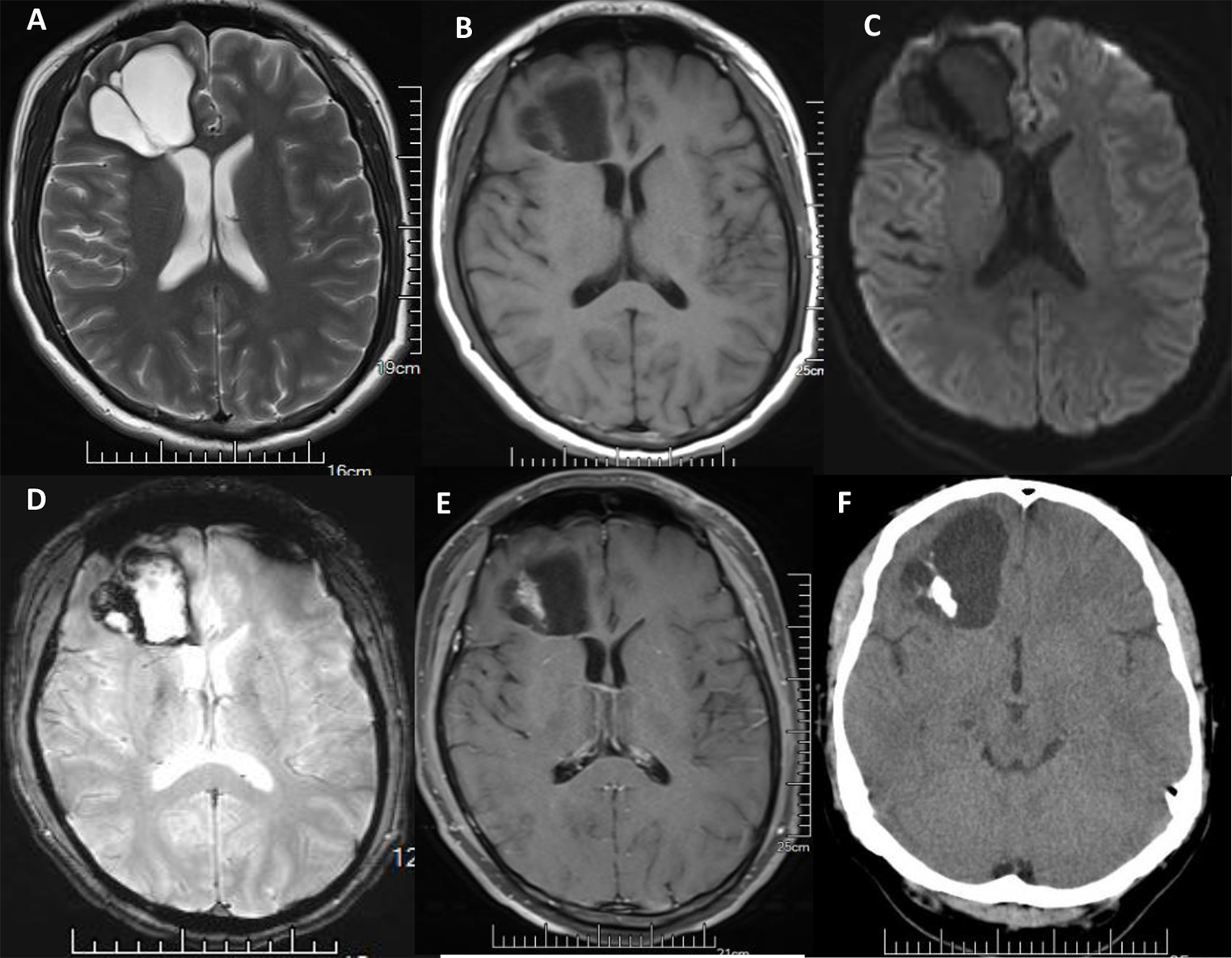 Imaging manifestations of papillary glioneuronal tumors