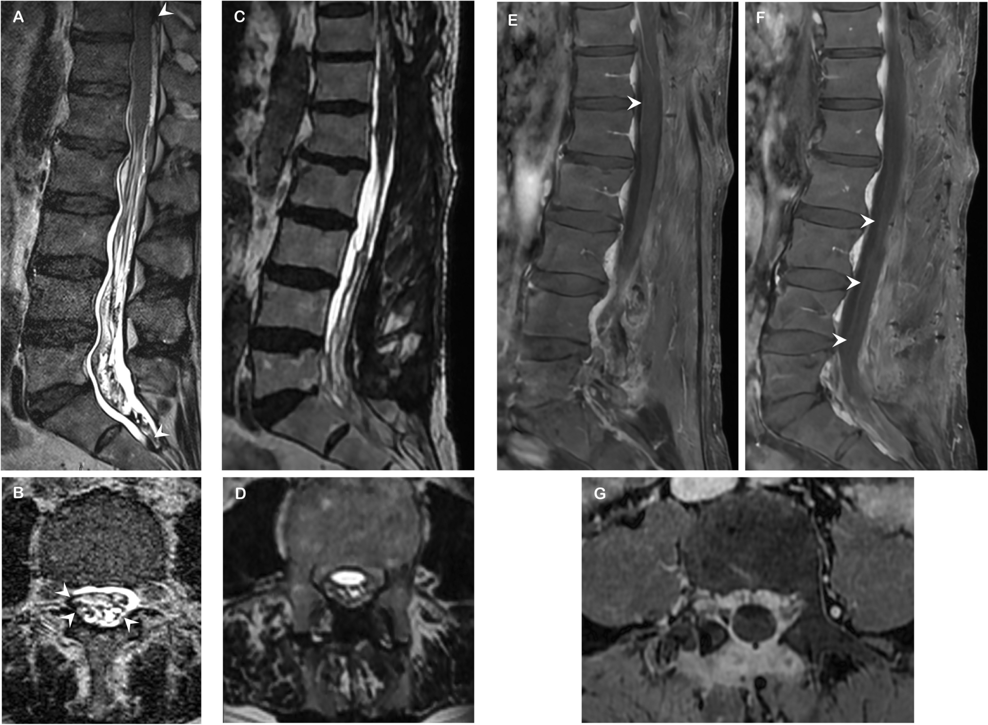 Spontaneous acute-onset conus medullaris or cauda equina syndrome: beware of spinal acute subdural hematoma