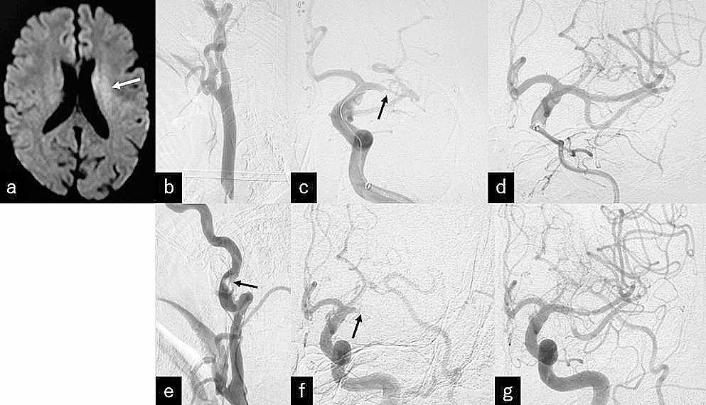 Unusually elongated superior thyroid cornu associated with recurrent cerebral embolisms