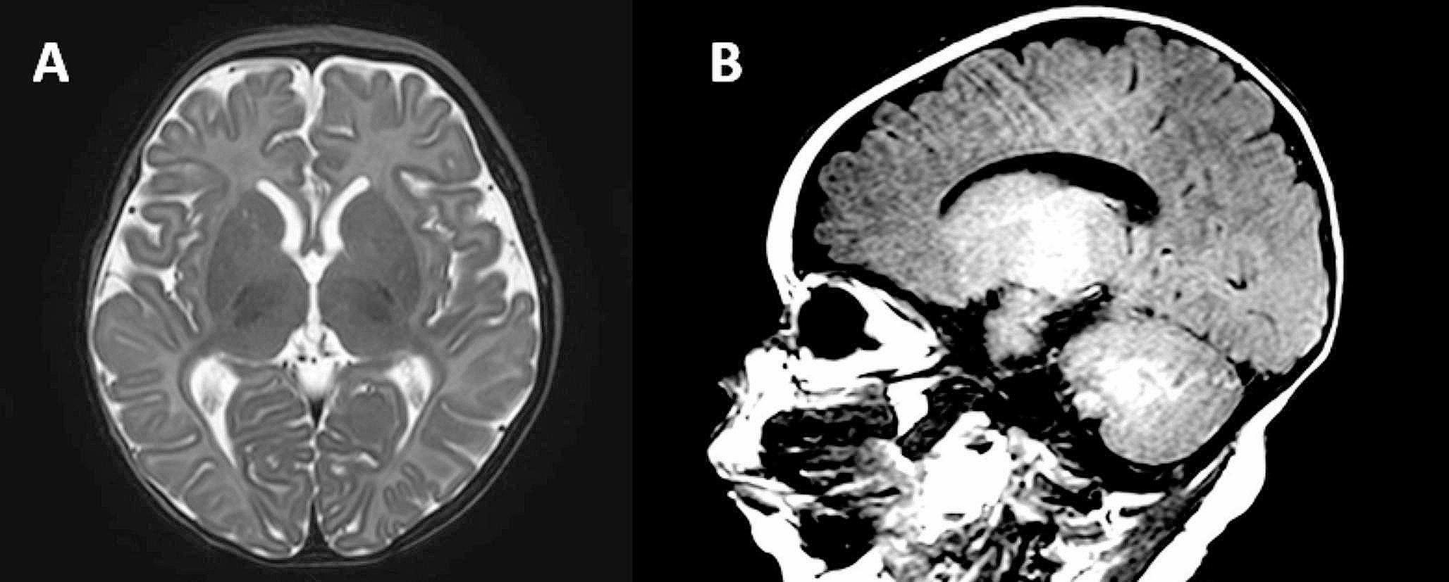 Early-onset dysphagia and severe neurodevelopmental disorder as early signs in a patient with two novel variants in NARS1: a case report and brief review of the literature