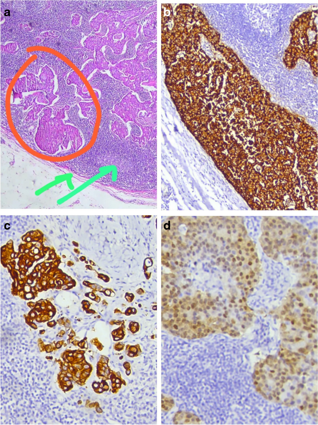 Isolated Inguinal Lymph Node Metastasis from Colon Cancer: A Case Report