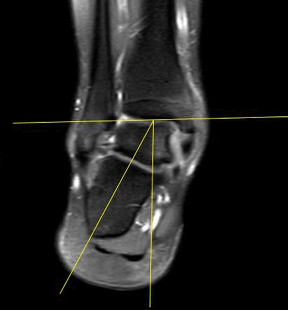 Coxa pedis: can calcaneal pronation angle be considered a predictive sign of medial plantar arch overload?