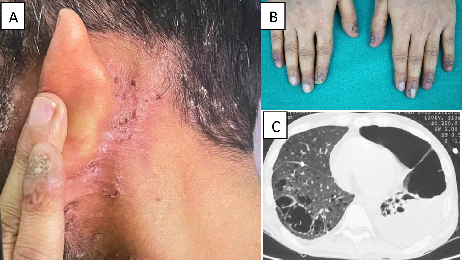 Adult Langerhans Cell Histiocytosis Presenting With Skin Lesions, Sclerosing Cholangitis and Pneumothorax