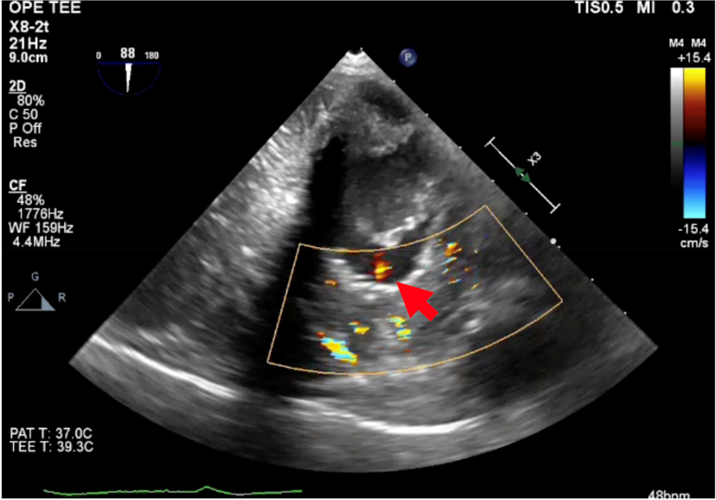 Iatrogenic coronary artery fistula that developed during septal myectomy was detected intraoperatively through transesophageal echocardiography