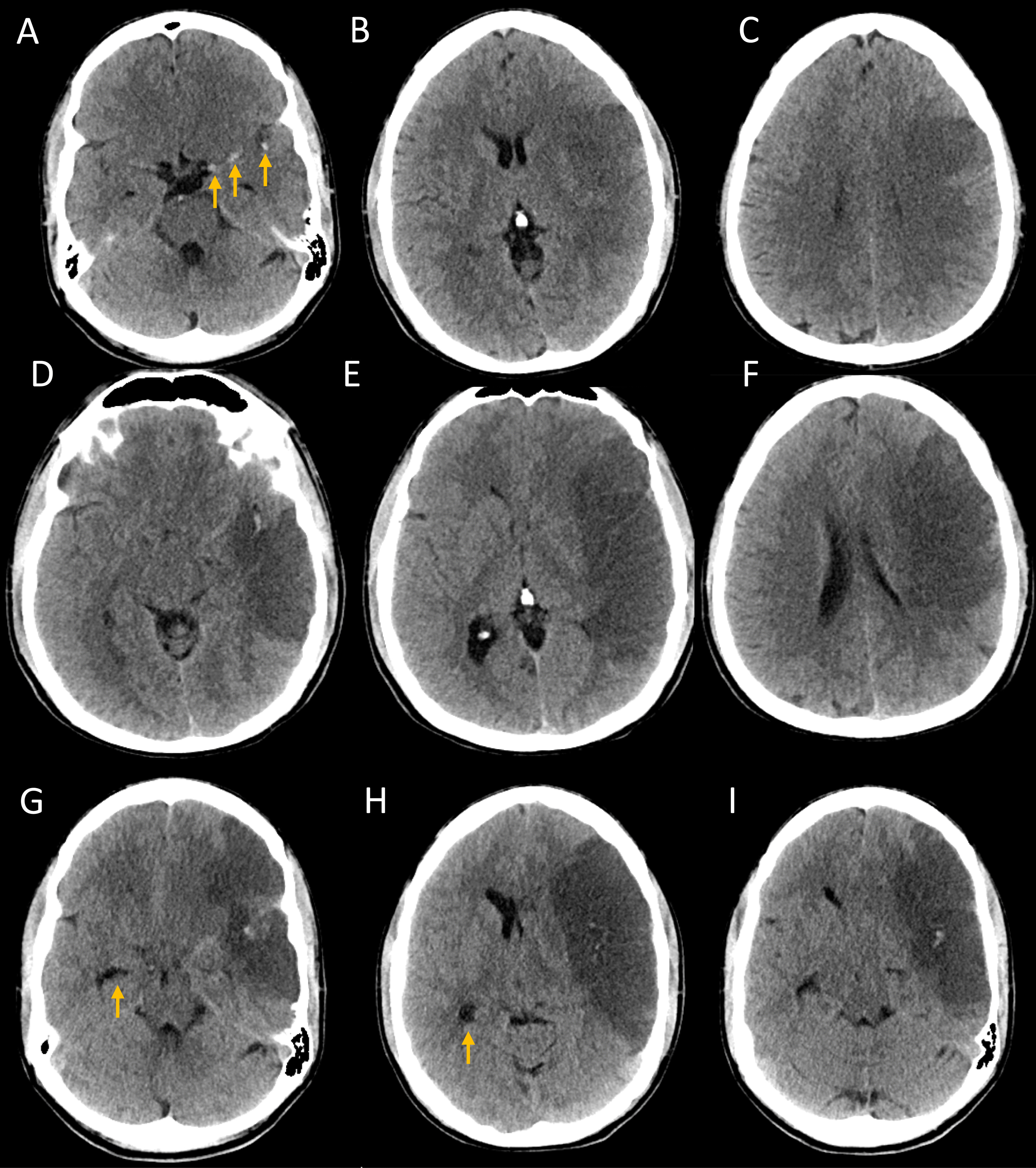 Treatment of Malignant Cerebral Edema in Acute Ischemic Stroke