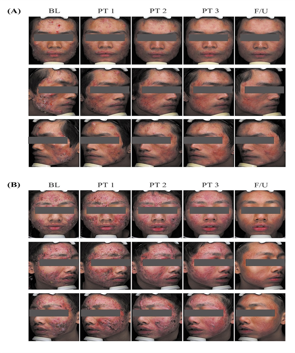 Efficacy and safety of single microneedle radiofrequency vs. photodynamic therapy on moderate-to-severe acne vulgaris: A prospective, randomized, controlled study