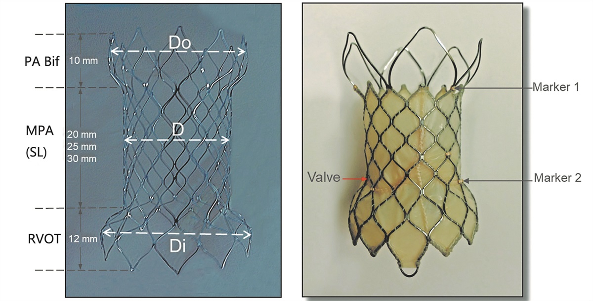 In vitro bench testing using patient-specific 3D models for percutaneous pulmonary valve implantation with Venus P-valve