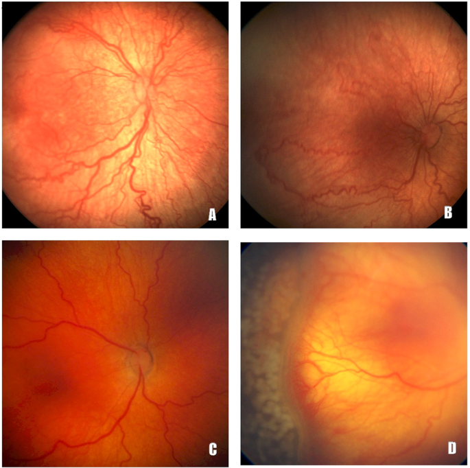 The Royal College of Paediatrics and Child Health Retinopathy of Prematurity Screening Guidelines (2022): a series of treated infants falling outside the updated criteria