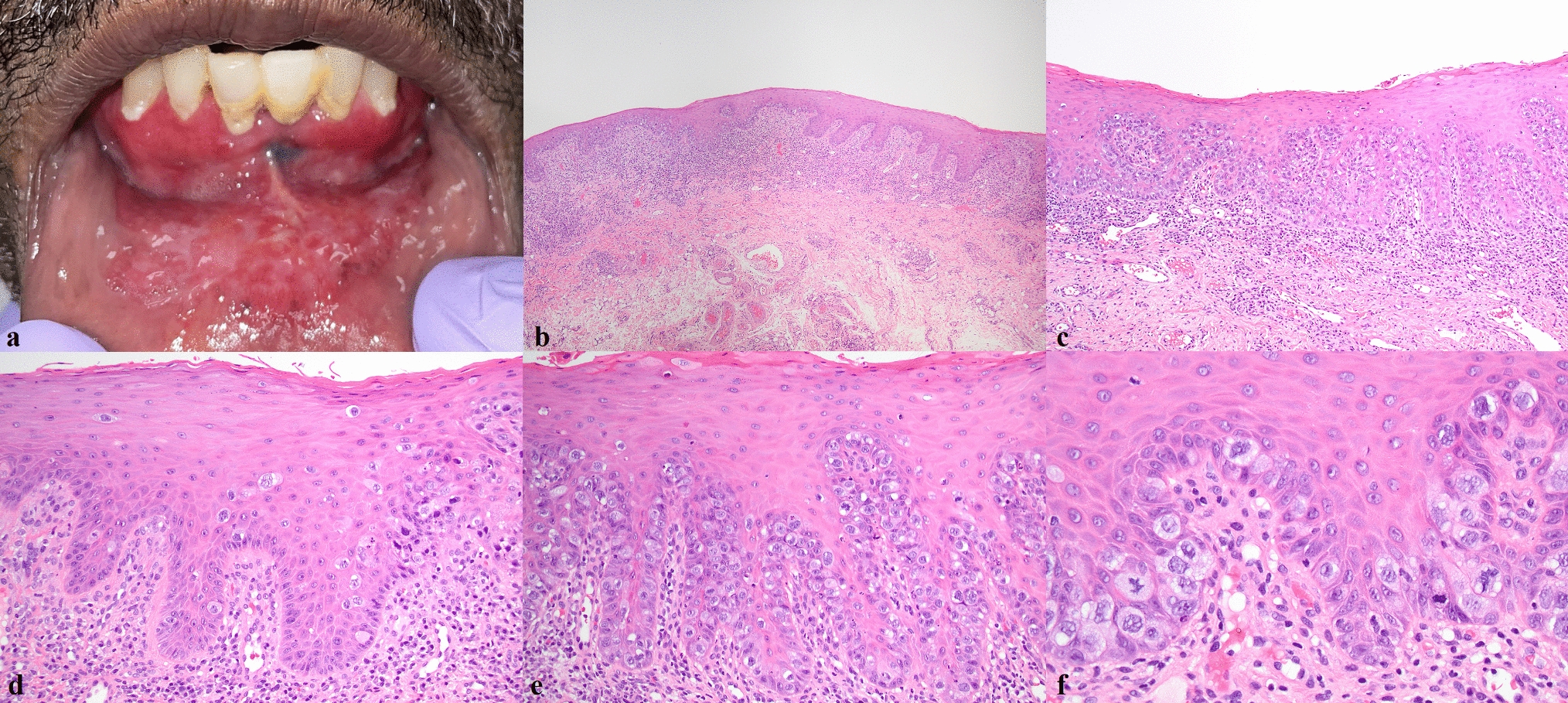Extramammary Paget Disease of Oral Mucosa: Case Report with Literature Review