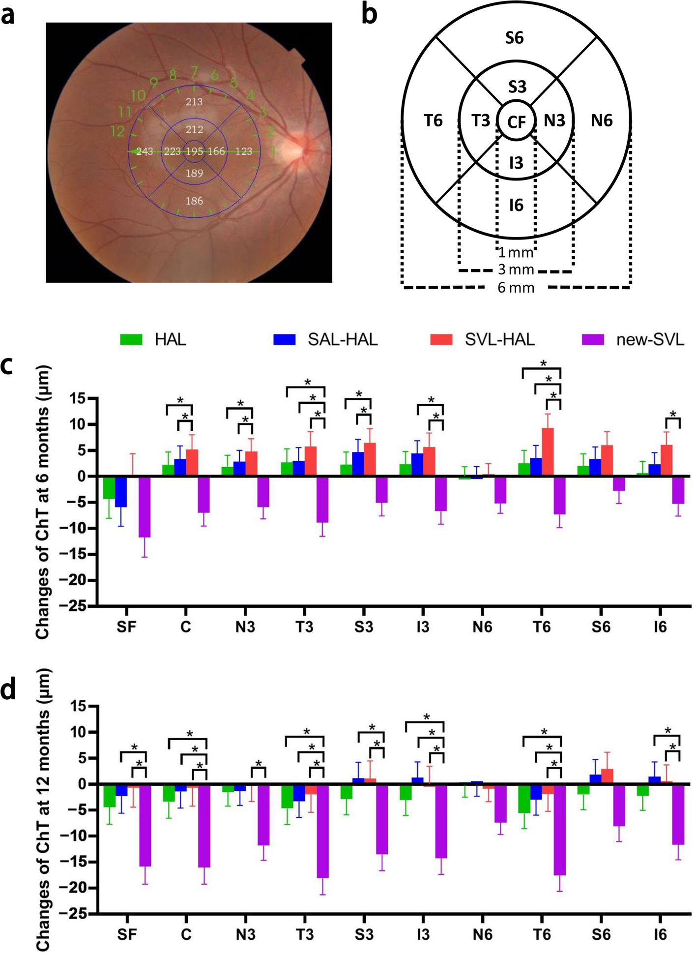 Effect of spectacle lenses with aspherical lenslets on choroidal thickness in myopic children: a 3-year follow-up study