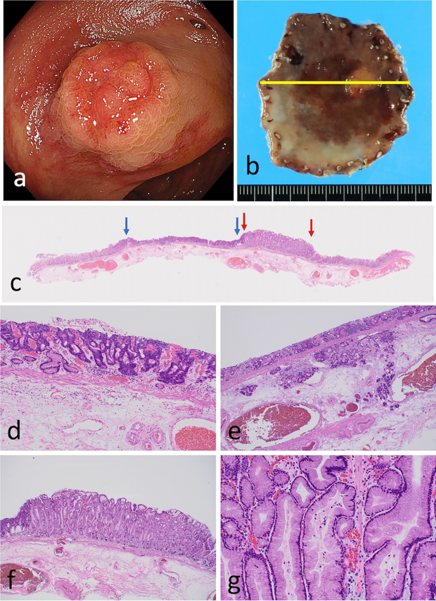 A gastric invasive tubular adenocarcinomatous lesion arising from foveolar-type neoplasia: molecular histogenesis