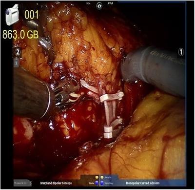 Safety and oncological outcome of early intraoperative intravesicle mitomycin C vs. deferred instillation in patients receiving robot-assisted radical nephroureterectomy