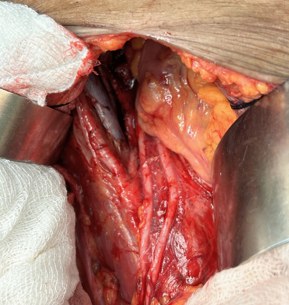 Duplicated Ureter: A Rare Anatomical Variation Diagnosed Incidentally During Open Radical Hysterectomy for Carcinoma Endometrium and Avoidance of Mishappening: A Case Report