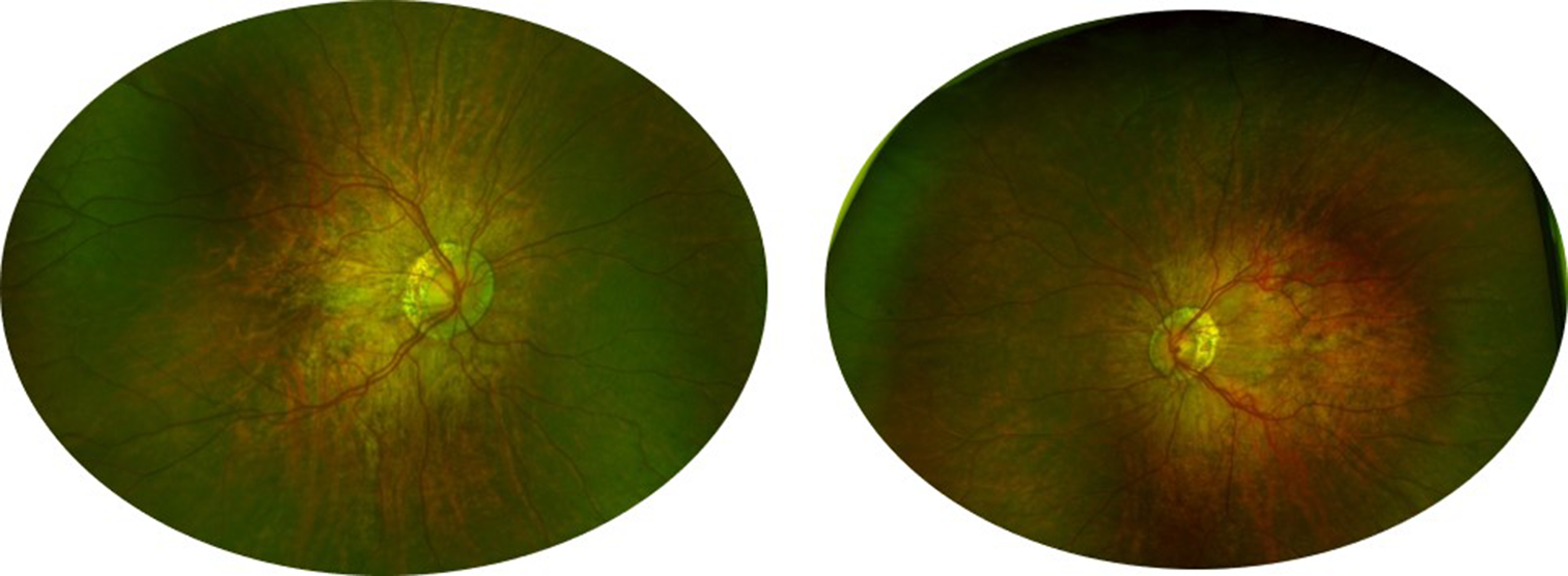 Macular hypoplasia and high myopia in 48, xxyy syndrome: a unique case of 48, xxyy syndrome that presents with high myopia and macular dysplasia