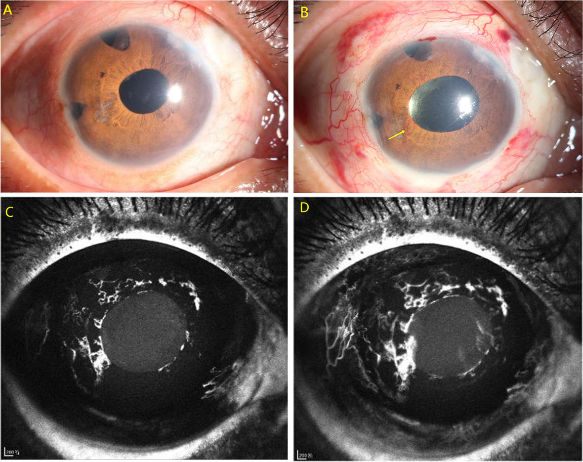 Iris neovascularization and neurotrophic keratopathy following ultrasound cycloplasty in refractory glaucoma: case series