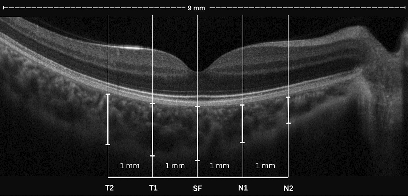 Assessing acute nicotine impact on choroidal thickness: a randomized, double-blinded study comparing smoking cessation aids, including nicotine gum and electronic cigarettes