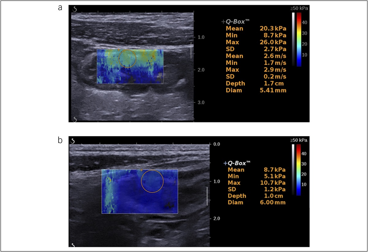 Bowel Stiffness Assessed by Shear-Wave Ultrasound Elastography Predicts Disease Behavior Progression in Patients With Crohn's Disease