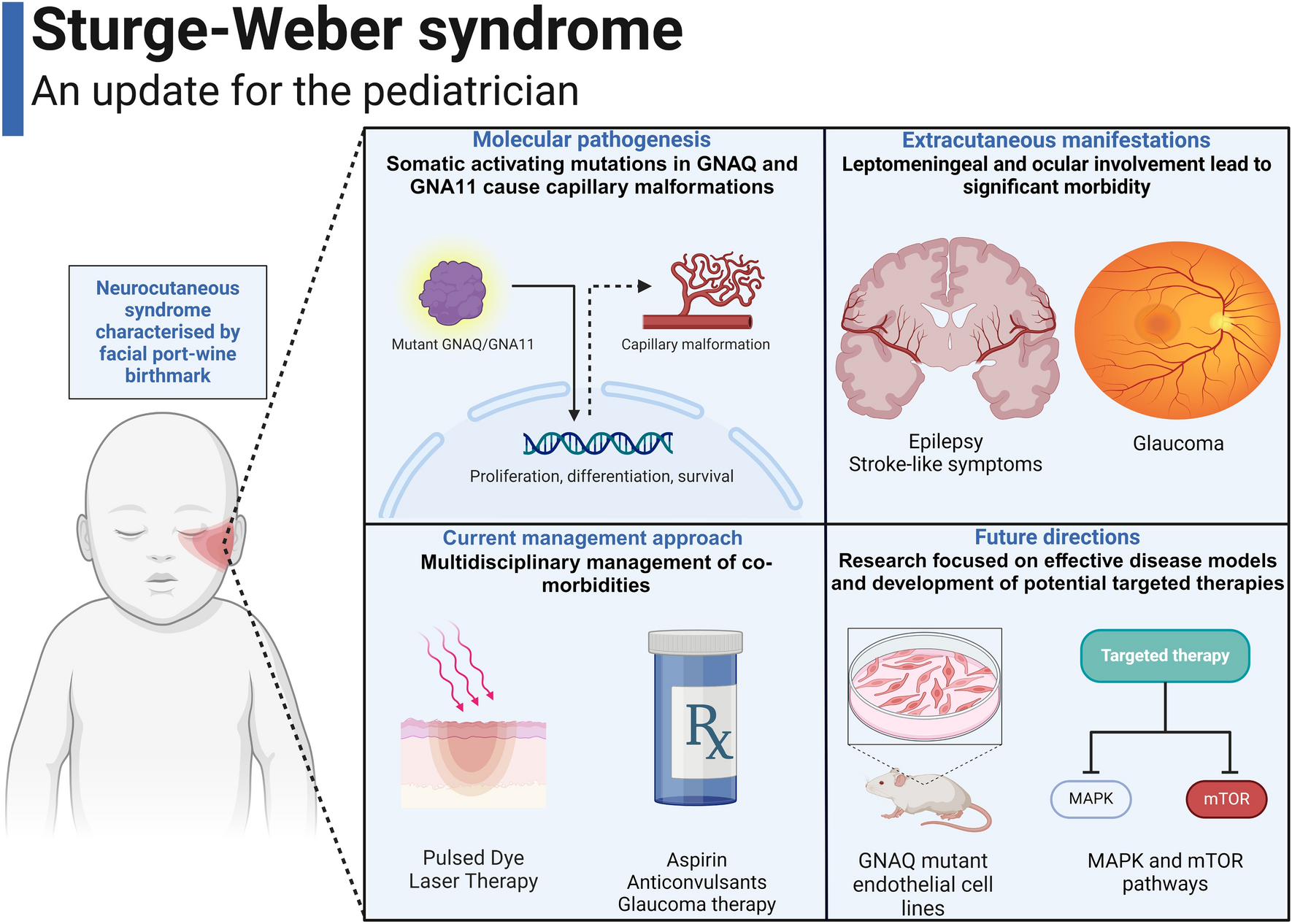 Sturge–Weber syndrome: an update for the pediatrician