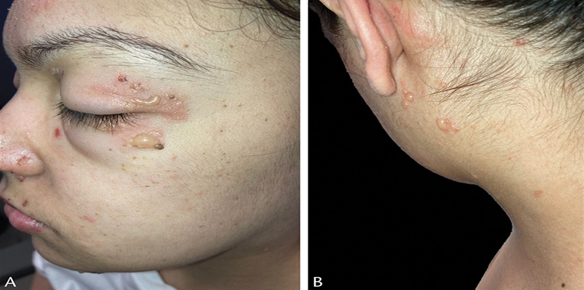 Small Vesicles and Tense Bullae on Face, Neck, and Upper Trunk: Challenge
