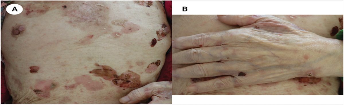 Bullous Dermatosis on the Whole Body: Challenge