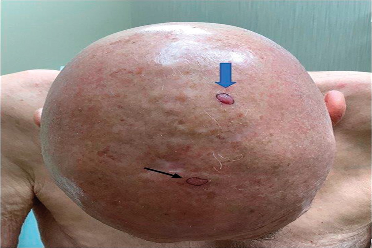 A Tale of Two Tumors: A Collision Tumor of Atypical Fibroxanthoma and Basal Cell Carcinoma