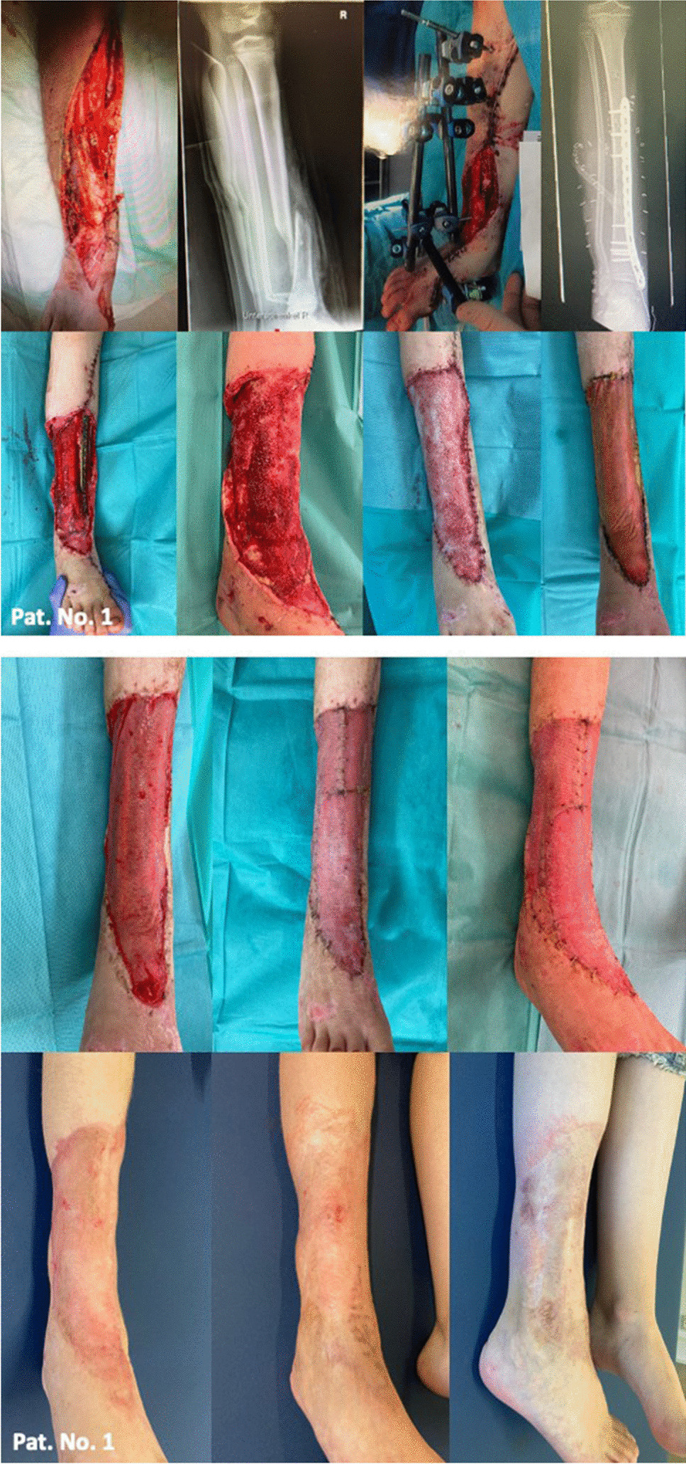 NovoSorb® Biodegradable Temporizing Matrix: a novel approach for treatment of extremity avulsion injuries in children