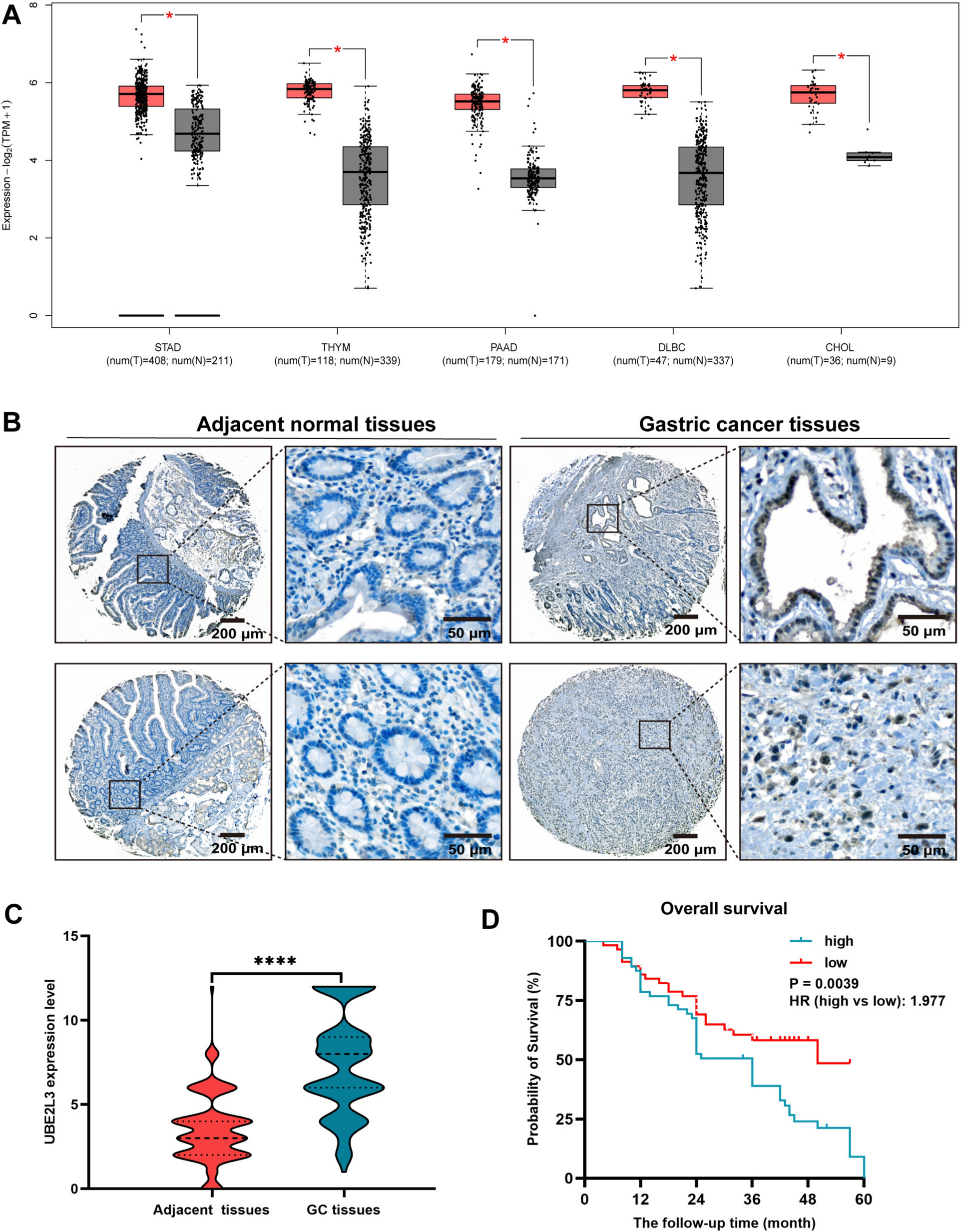 UBE2L3 expression in human gastric cancer and its clinical significance