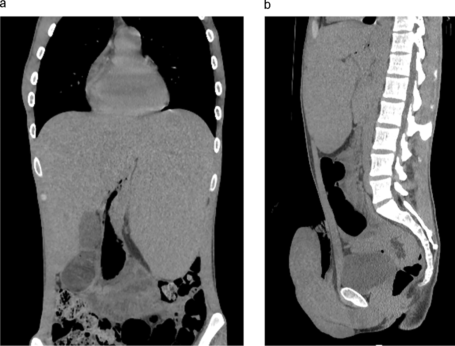 Priapism as an initial manifestation in an adult patient with chronic myeloid leukemia in Japan: case report and review of the literature