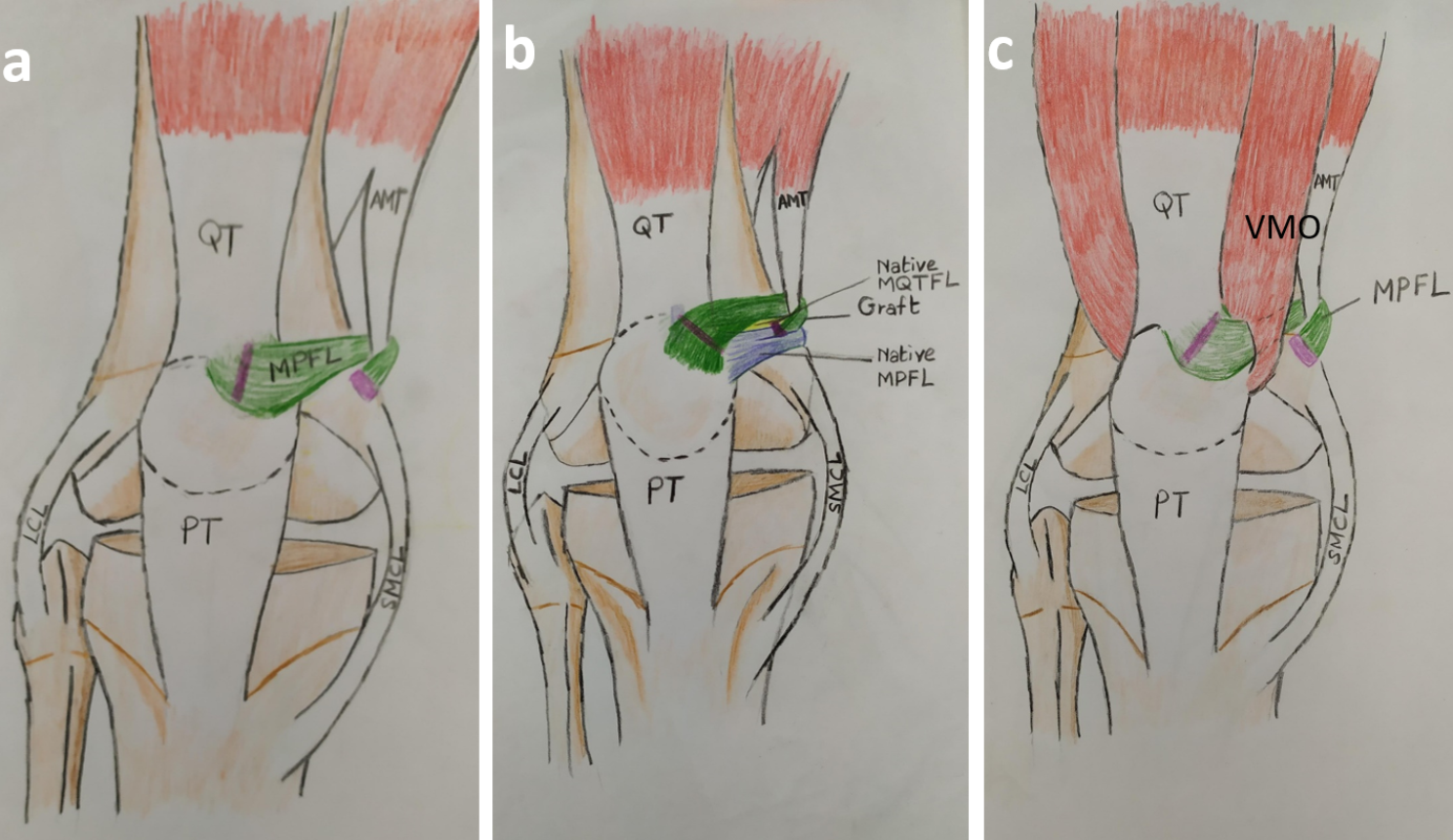 Outcomes of surgical treatment of patellar instability in children with Down syndrome